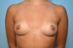 Breast Augmentation