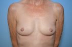 Breast Augmentation