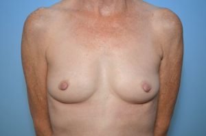 Breast Augmentation