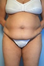 Abdominoplasty Liposuction