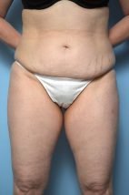 Standard Tummy Tuck with liposuction