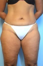 Umbilical Float Tummy Tuck with Liposuction