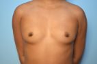 Breast Augmentation