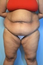 Abdominoplasty Liposuction