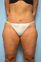 Umbilical Float Tummy Tuck with Liposuction