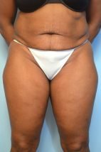 Abdominoplasty, Liposuction