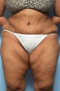 Abdominoplasty Liposuction