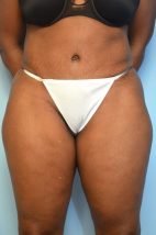 Abdominoplasty, Liposuction