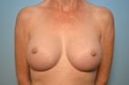 Breast Augmentation