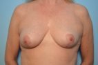 Breast Reduction