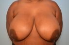 Breast Reduction