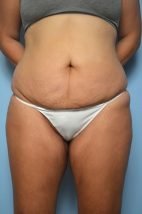 Abdominoplasty, Tummy Tuck, Liposuction