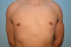 Gynecomastia Reduction