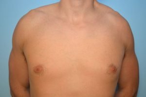 Gynecomastia Reduction