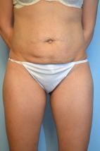 Abdominoplasty