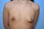 Correction of Tubular Breast Deformity