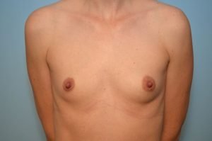 Breast Augmentation