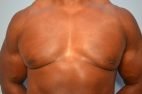 Gynecomastia Reduction