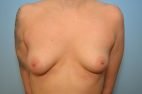 Breast Asymmetry Correction