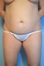 Umbilical Float Tummy Tuck, Liposuction