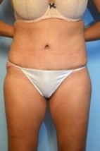 Abdominoplasty