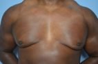 Gynecomastia Reduction