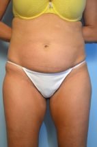 Abdominoplasty