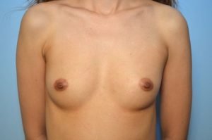 Breast Augmentation