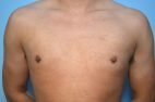 Gynecomastia Reduction