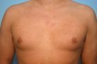 Gynecomastia Reduction