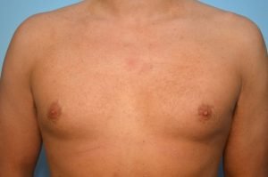 Gynecomastia Reduction