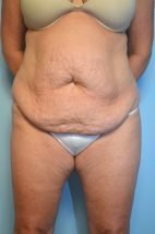 Tummy Tuck Liposuction