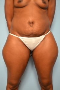 Abdominoplasty