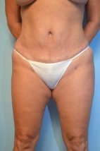 Tummy Tuck Liposuction