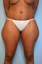 Abdominoplasty