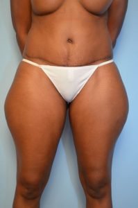 Abdominoplasty