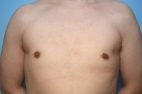 Gynecomastia Reduction