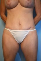 Umbilical Float Tummy Tuck