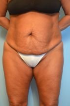 Abdominoplasty and liposuction