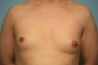 Gynecomastia Reduction