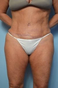 Abdominoplasty and liposuction