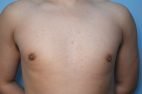 Gynecomastia Reduction