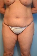 Tummy Tuck, liposuction