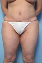 Tummy Tuck, liposuction