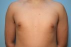 Gynecomastia Reduction