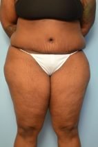 Standard Tummy Tuck