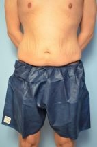 Male Tummy Tuck