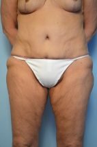 Standard Tummy Tuck and liposuction