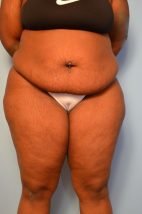 Standard Tummy Tuck