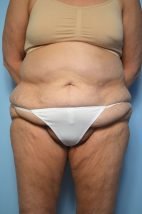 Standard Tummy Tuck and liposuction